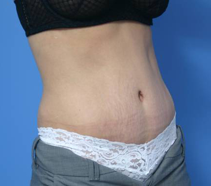 pictures swelling after tummy tuck
